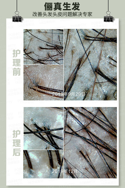 頭油、頭癢