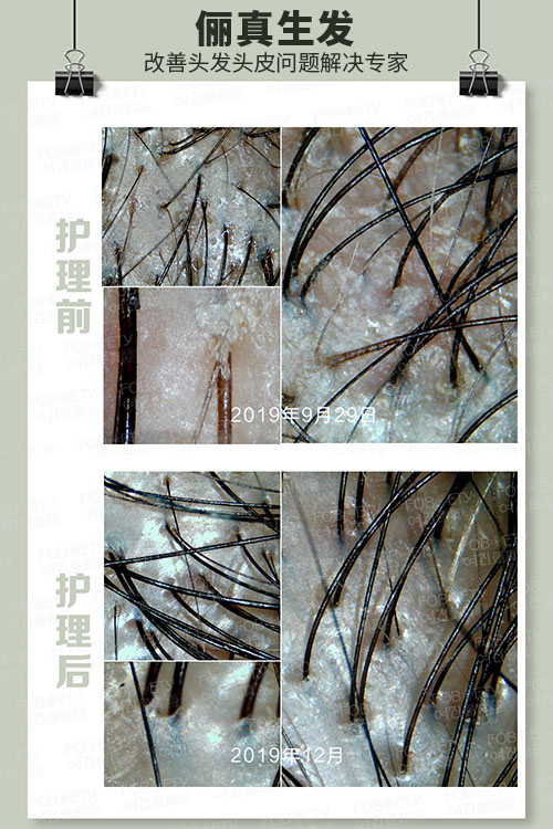 頭油、頭癢